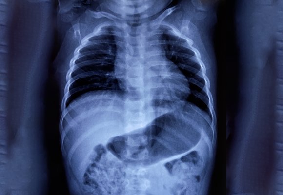 Thoracoscopy